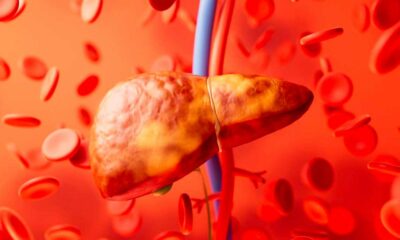 Esteatosis hepática y cannabinoides